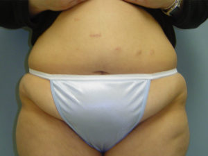 tummy tuck patient