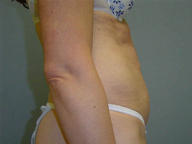 tummy tuck patient