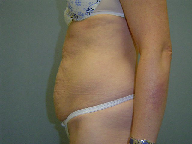 tummy tuck patient