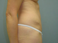 tummy tuck patient