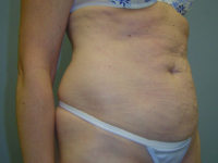 tummy tuck patient