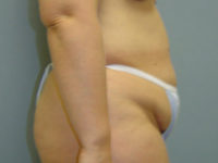 tummy tuck patient