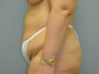 tummy tuck patient