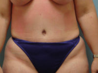 tummy tuck patient