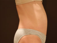 tummy tuck patient