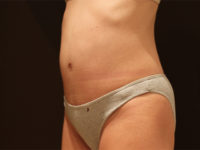 tummy tuck patient
