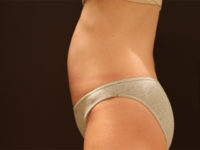tummy tuck patient