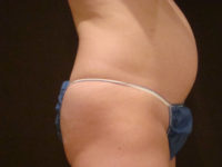 tummy tuck patient