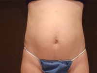 tummy tuck patient