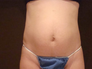 tummy tuck patient