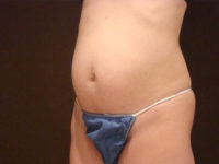 tummy tuck patient