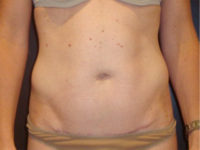 tummy tuck patient