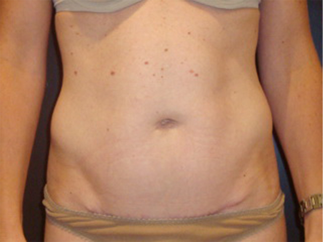 tummy tuck patient