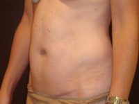 tummy tuck patient