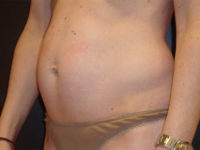 tummy tuck patient