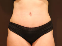 tummy tuck patient
