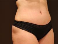tummy tuck patient
