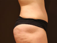 tummy tuck patient