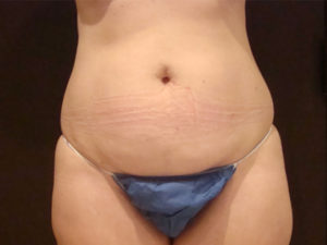 tummy tuck patient