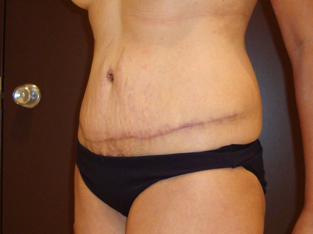 tummy tuck patient