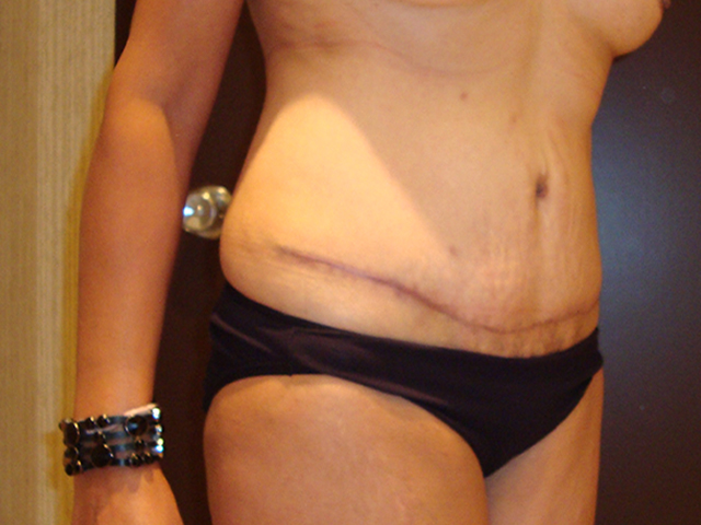 tummy tuck patient