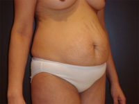 tummy tuck patient