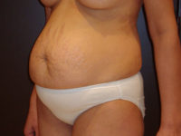 tummy tuck patient