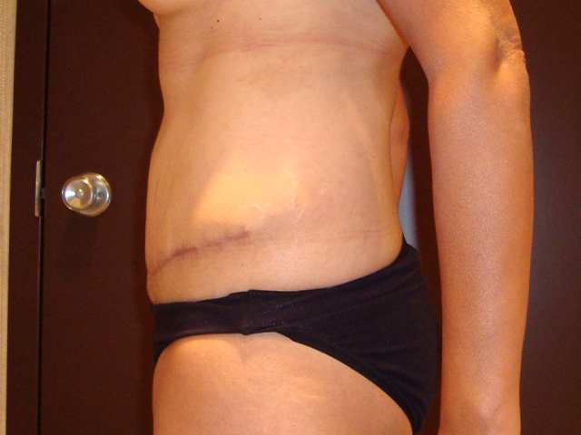 tummy tuck patient