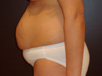 tummy tuck patient