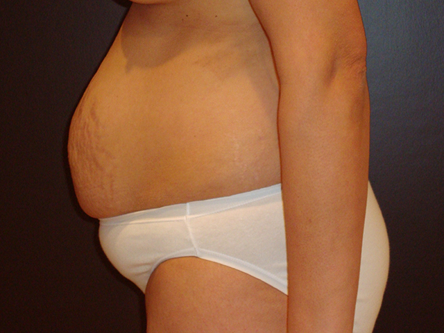 tummy tuck patient