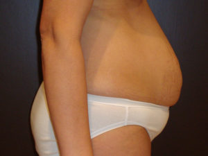 tummy tuck patient