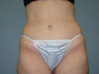 tummy tuck patient