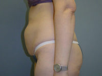 tummy tuck patient