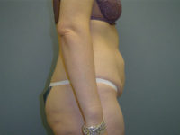 tummy tuck patient
