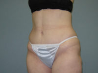 tummy tuck patient