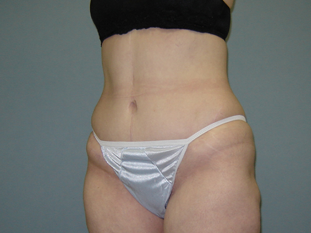tummy tuck patient