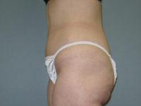 tummy tuck patient