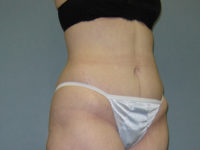 tummy tuck patient