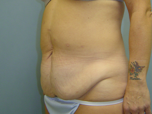 tummy tuck patient