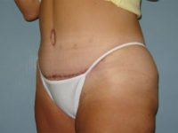 tummy tuck patient