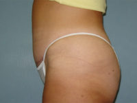 tummy tuck patient