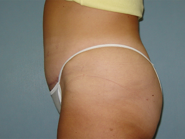 tummy tuck patient