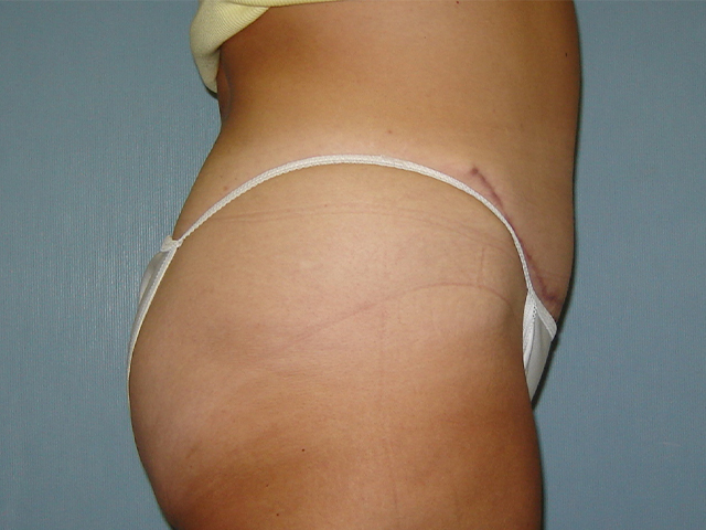 tummy tuck patient