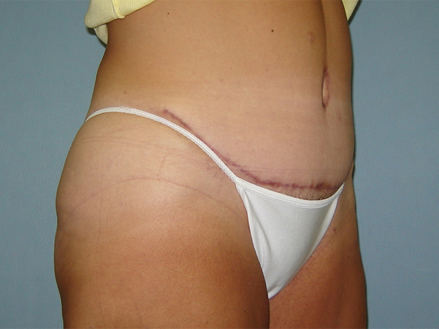 tummy tuck patient