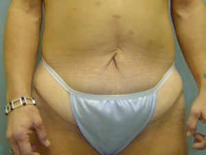 tummy tuck patient