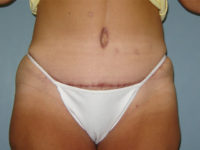 tummy tuck patient