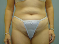 tummy tuck patient