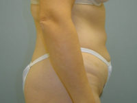 tummy tuck patient