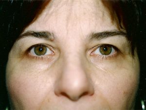 blepharoplasty patient