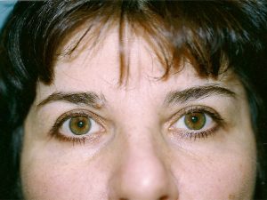 blepharoplasty patient